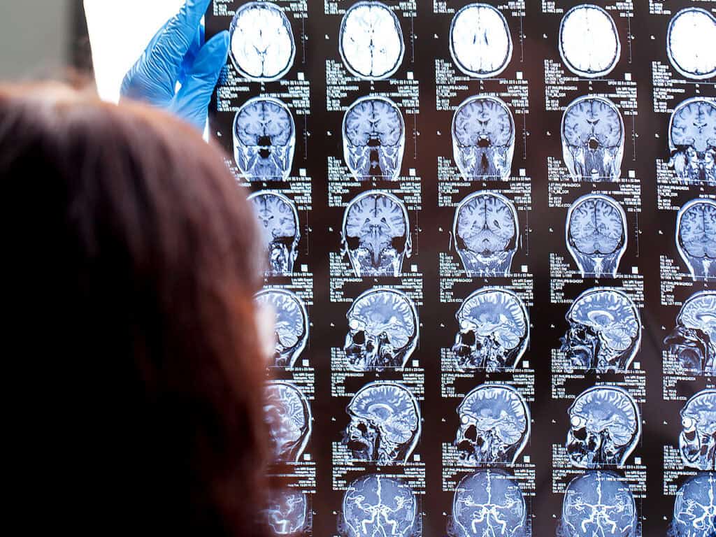 What to Know About Traumatic Brain Injuries – Goss Law